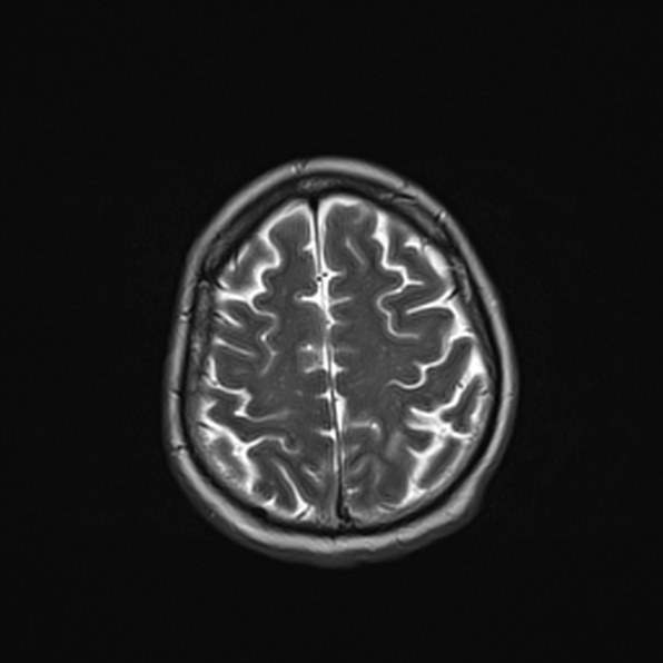 Cerebral abscess (Radiopaedia 26111-26247 Axial T2 48).jpg