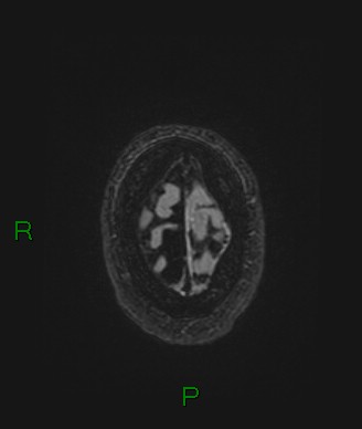 File:Cerebral abscess and subdural empyema (Radiopaedia 84436-99779 Axial FLAIR 12).jpg