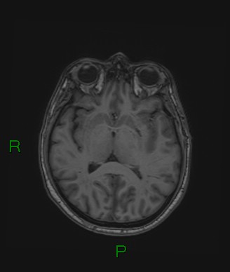 Cerebral abscess and subdural empyema (Radiopaedia 84436-99779 Axial T1 44).jpg