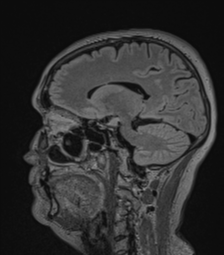 Cerebral abscess from pulmonary arteriovenous malformation (Radiopaedia 86275-102291 Sagittal FLAIR 31).png
