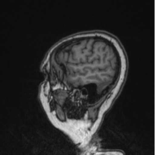 Cerebral abscess from pulmonary arteriovenous malformation (Radiopaedia 86275-102291 Sagittal T1 27).png