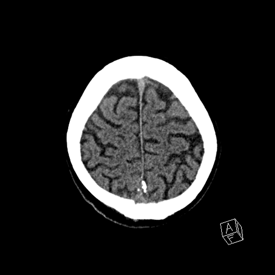 Cerebral abscess with ventriculitis (Radiopaedia 78965-91876 Axial non-contrast 42).jpg