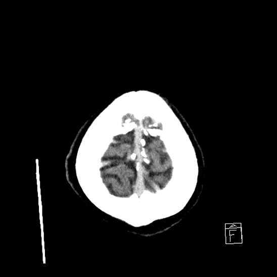 File:Cerebral abscess with ventriculitis (Radiopaedia 78965-91877 A 45).jpg