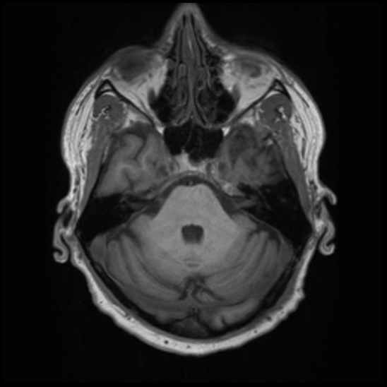 File:Cerebral abscess with ventriculitis (Radiopaedia 78965-91878 Axial T1 13).jpg