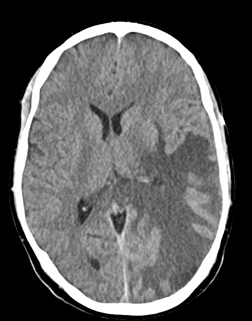 Cerebral abscesses (Radiopaedia 70458-80568 Axial non-contrast 34).jpg