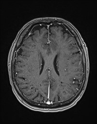 Cerebral amyloid angiopathy-related inflammation (Radiopaedia 58270-65377 Axial T1 C+ fat sat 95).jpg