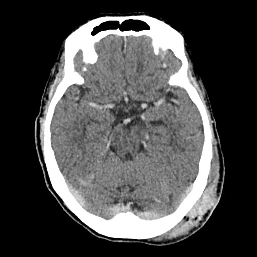 Cerebral amyloid angiopathy-related inflammation (Radiopaedia 74836-85848 Axial non-contrast 25).jpg
