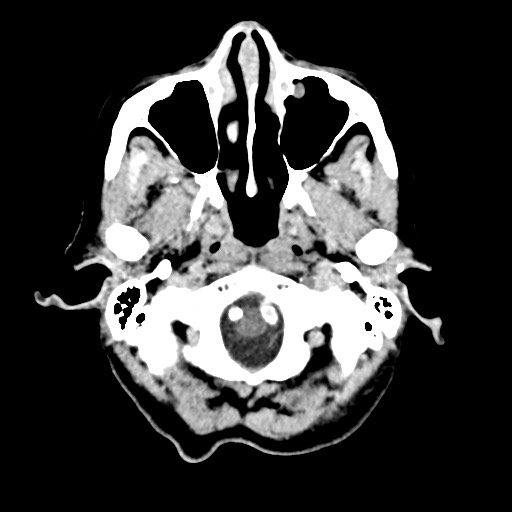 File:Cerebral amyloid angiopathy-related inflammation (Radiopaedia 74836-85848 Axial non-contrast 8).jpg