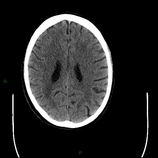 Cerebral amyloid angiopathy (Radiopaedia 77506-89665 Axial non-contrast 70).jpg