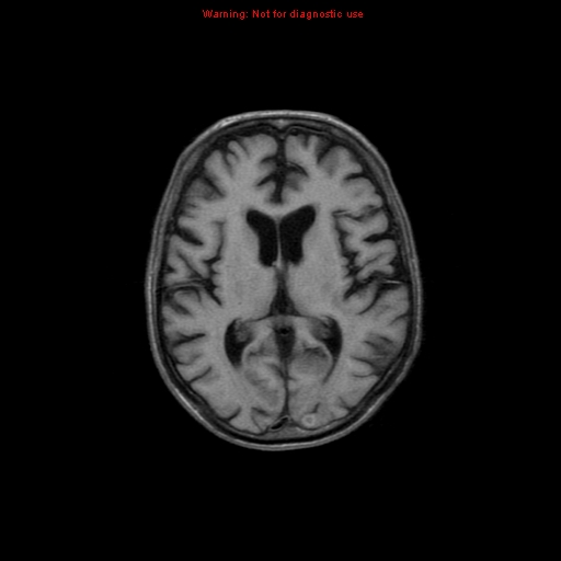 File:Cerebral and orbital tuberculomas (Radiopaedia 13308-13311 Axial T1 12).jpg