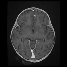 Cerebral and spinal tuberculosis (Radiopaedia 90489-107837 Axial T1 C+ 94).jpg