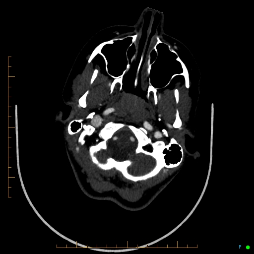 Cerebral arteriovenous malformation (AVM) (Radiopaedia 78162-90706 Axial CTA 49).jpg