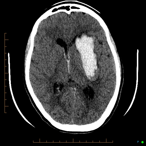 Cerebral arteriovenous malformation (AVM) (Radiopaedia 78162-90706 Axial non-contrast 34).jpg