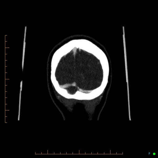 Cerebral arteriovenous malformation (AVM) (Radiopaedia 78162-90706 Coronal CTA 13).jpg