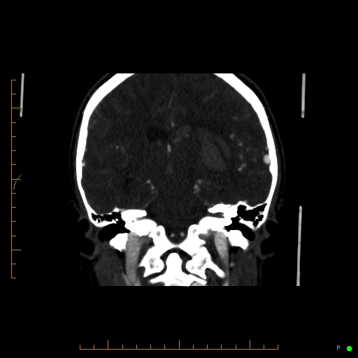 Cerebral arteriovenous malformation (AVM) (Radiopaedia 78162-90706 Coronal CTA 47).jpg