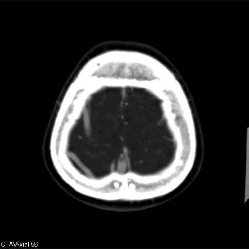 Cerebral arteriovenous malformation (Radiopaedia 28518-28759 B 56).jpg