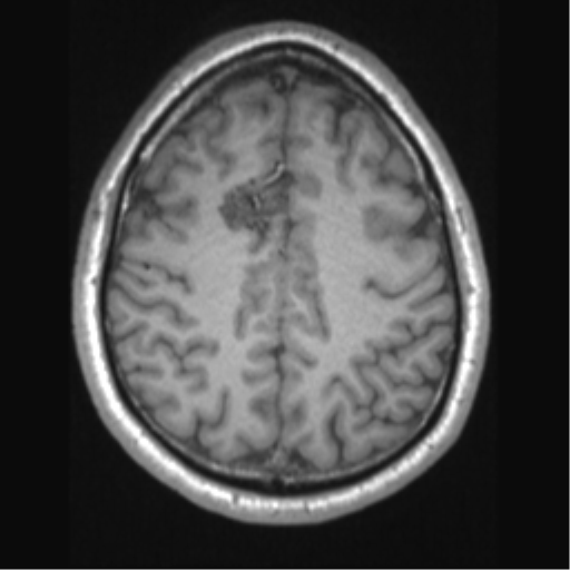 Cerebral arteriovenous malformation (Radiopaedia 39259-41506 Axial T1 56).png