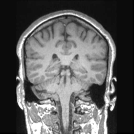 File:Cerebral arteriovenous malformation (Radiopaedia 39259-41506 Coronal T1 37).png