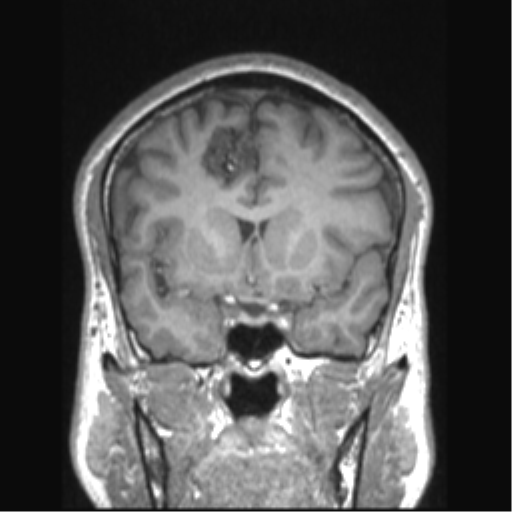 File:Cerebral arteriovenous malformation (Radiopaedia 39259-41506 Coronal T1 59).png