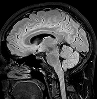 Cerebral arteriovenous malformation (Radiopaedia 74411-85746 Sagittal FLAIR 53).jpg