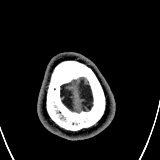Cerebral arteriovenous malformation (Radiopaedia 78188-90746 Axial C+ delayed 165).jpg