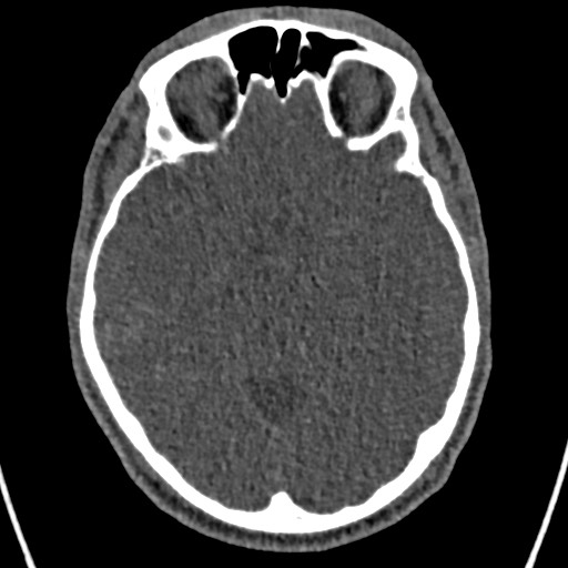 Cerebral arteriovenous malformation (Radiopaedia 78188-90746 Axial non-contrast 71).jpg