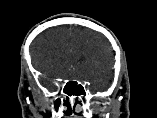 Cerebral arteriovenous malformation (Radiopaedia 78188-90746 Coronal C+ delayed 35).jpg
