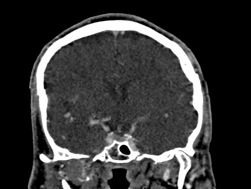 Cerebral arteriovenous malformation (Radiopaedia 78188-90746 Coronal C+ delayed 50).jpg