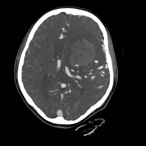 File:Cerebral arteriovenous malformation (Radiopaedia 79677-92888 A 30).jpg