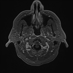 Cerebral arteriovenous malformation (Radiopaedia 84015-99245 Axial T1 C+ 12).jpg