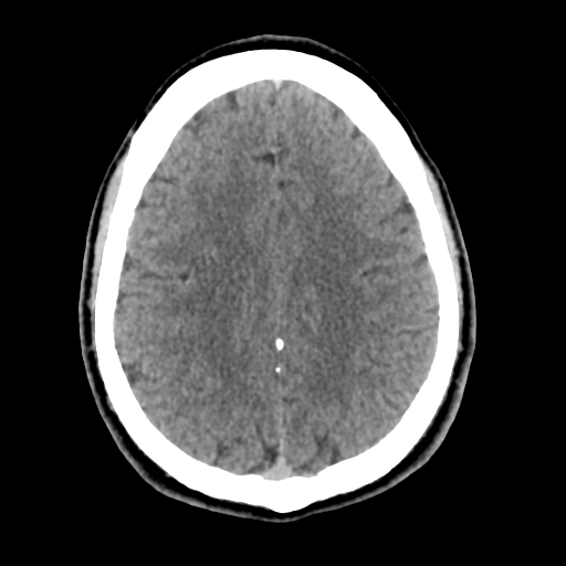 File:Cerebral arteriovenous malformation (Spetzler-Martin grade 2) (Radiopaedia 41262-44076 Axial non-contrast 40).png
