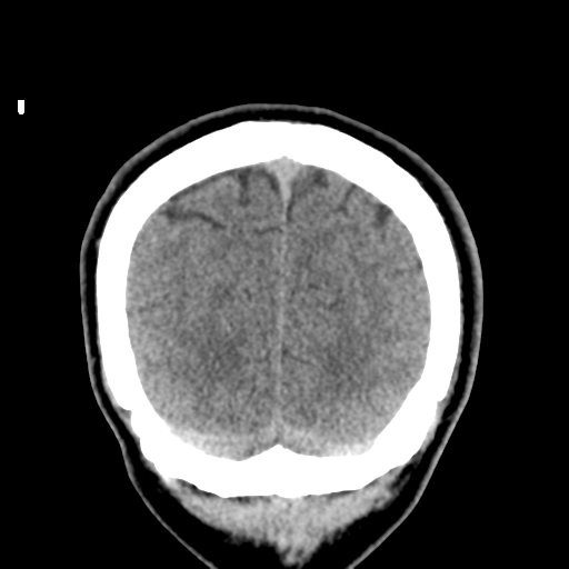 Cerebral arteriovenous malformation (Spetzler-Martin grade 2) (Radiopaedia 41262-44076 Coronal non-contrast 56).png