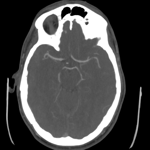 Cerebral arteriovenous malformation (Spetzler-Martin grade 2) (Radiopaedia 41262-44076 E 22).png