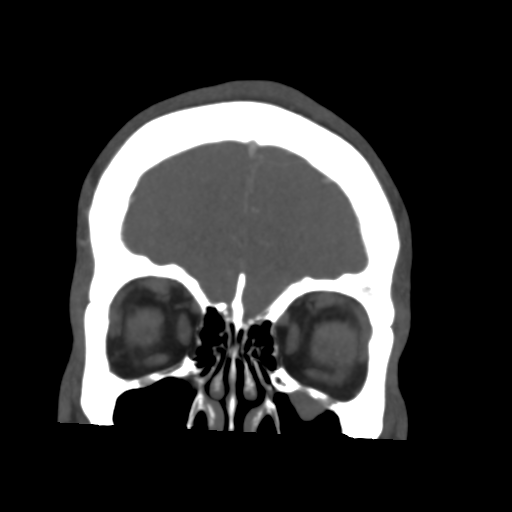 File:Cerebral arteriovenous malformation (Spetzler-Martin grade 2) (Radiopaedia 41262-44076 F 11).png