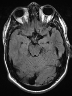 File:Cerebral arteriovenous malformation - huge (Radiopaedia 35734-37272 Axial FLAIR 8).png