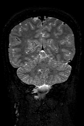 Cerebral arteriovenous malformation at posterior body of corpus callosum (Radiopaedia 74111-84925 Coronal T2 134).jpg