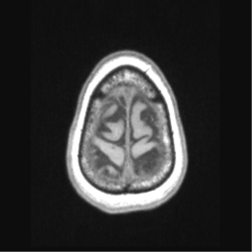 Cerebral arteriovenous malformation with hemorrhage (Radiopaedia 34422-35737 Axial T1 70).png
