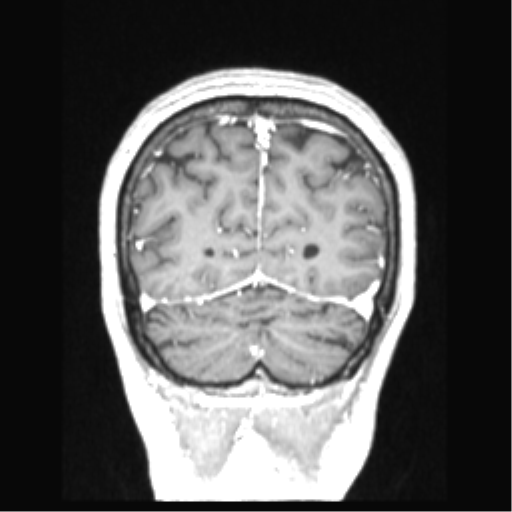 Cerebral arteriovenous malformation with hemorrhage (Radiopaedia 34422-35737 Coronal T1 C+ 20).png