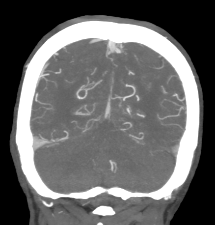 File:Cerebral arteriovenous malformation with lobar hemorrhage (Radiopaedia 44725-48511 B 45).png