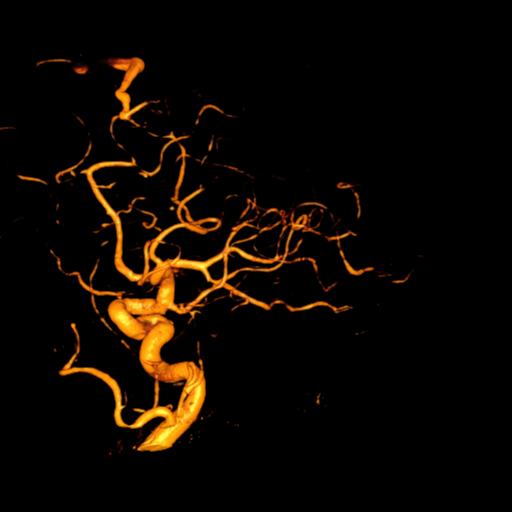 Cerebral arteriovenous malformation with lobar hemorrhage (Radiopaedia 44725-48513 Lateral 18).png