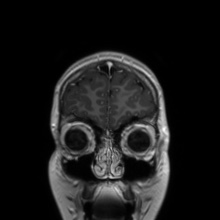 File:Cerebral cavernous venous malformation (Radiopaedia 70008-80021 Coronal T1 C+ 54).jpg