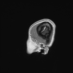 Cerebral cavernous venous malformation (Radiopaedia 70008-80021 Sagittal T1 C+ 2).jpg