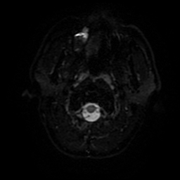 Cerebral cavernous venous malformation (Zabramski type II) (Radiopaedia 85511-101198 Axial DWI 68).jpg