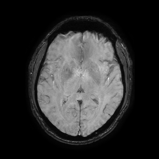 Cerebral cavernous venous malformation (Zabramski type II) (Radiopaedia 85511-101198 Axial SWI 66).jpg
