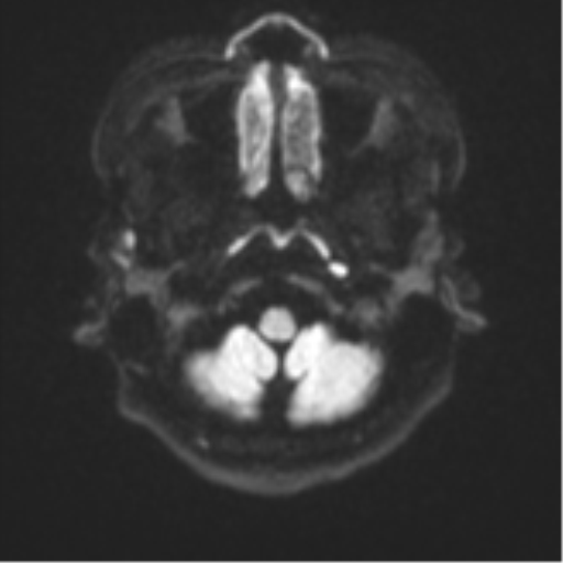 Cerebral cavernous venous malformations (Radiopaedia 48117-52946 Axial DWI 30).png
