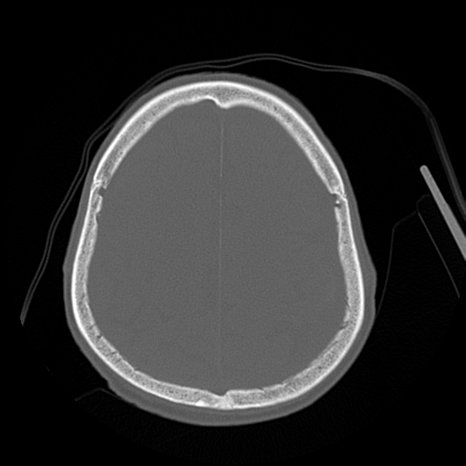 Cerebral contusions, subarachnoid hemorrhage and subdural hygromas (Radiopaedia 55399-61827 Axial bone window 39).png