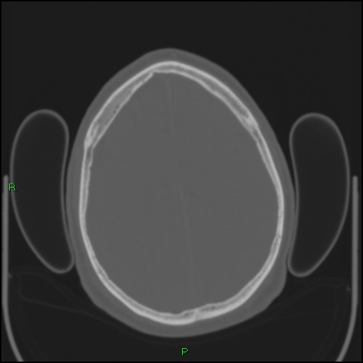 Cerebral contusions (Radiopaedia 33868-35039 Axial bone window 160).jpg