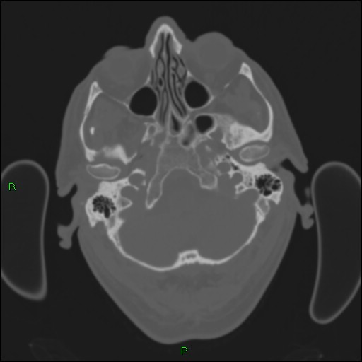 Cerebral contusions (Radiopaedia 33868-35039 Axial bone window 27).jpg