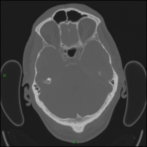 Cerebral contusions (Radiopaedia 33868-35039 Axial bone window 60).jpg