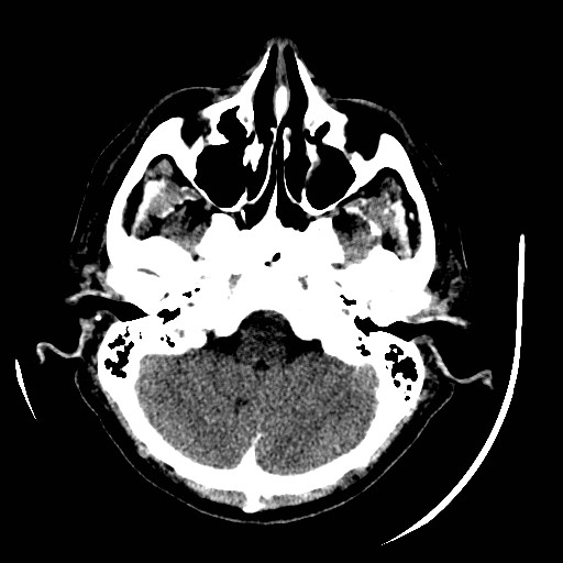 Cerebral edema (evolution in time) (Radiopaedia 19418-19440 non-contrast 21).jpg